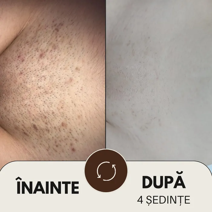 Rezultat epilare definitivă cu laser la Aliana Beauty Timișoara
