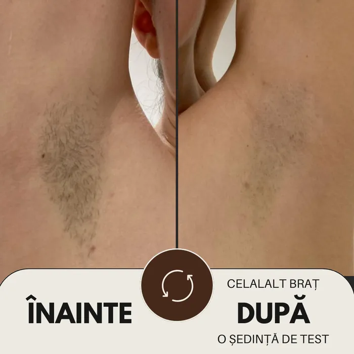 Reducere vizibilă a părului după ședințe de epilare definitivă cu laser, Timișoara