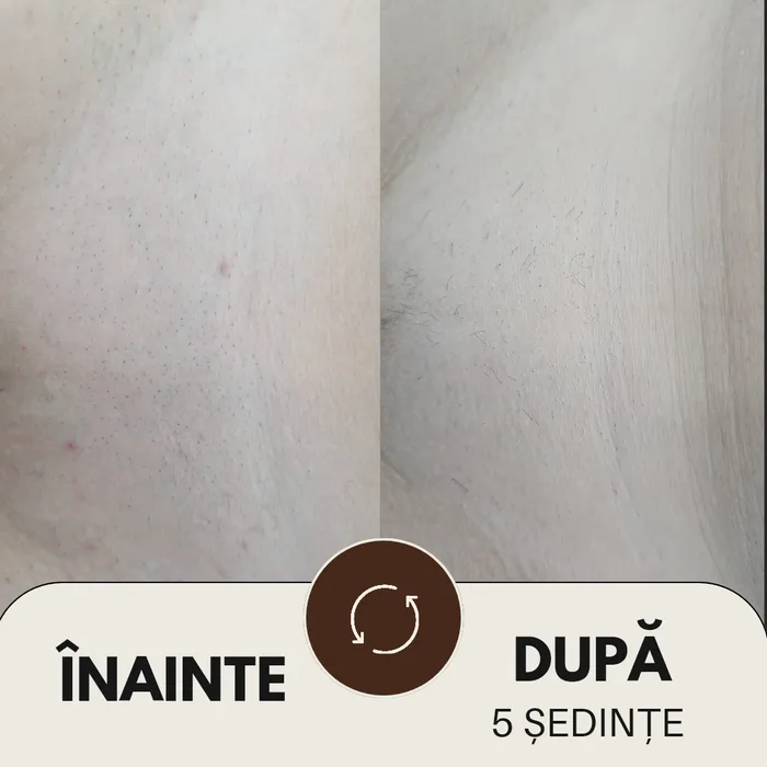 Rezultat după protocolul complet de epilare definitivă cu laser, Aliana Beauty Timișoara