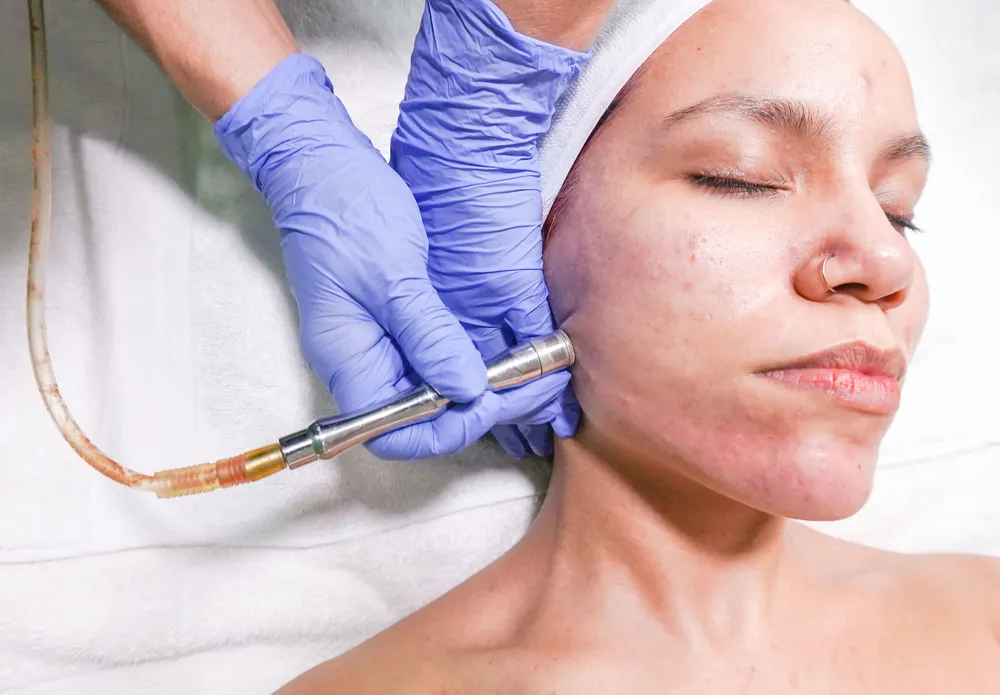 Microdermabraziune cu cap de diamant, exfoliere facială la Aliana Beauty în Timișoara